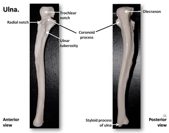 Ulna radius lateral annotated physiopedia wiring pedia physio